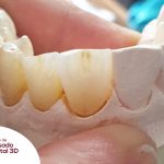 beneficios del zirconio