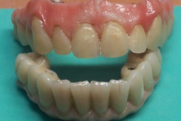 PERSONALIZACION DE PROTESIS