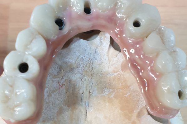 PERSONALIZACION DE PROTESIS