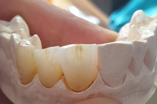 ZIRCONIO 3D 4D