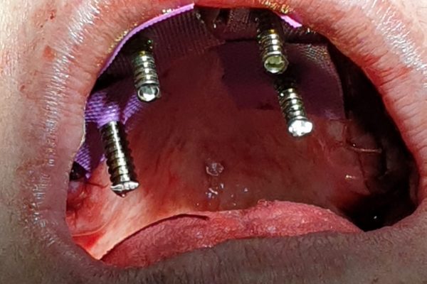 implantes cigomaticos
