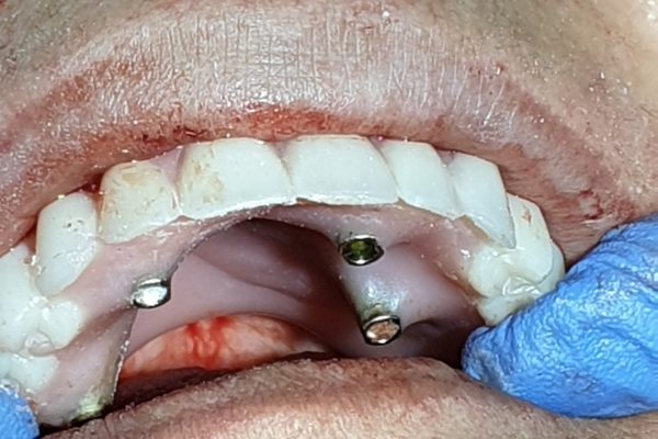 implantes cigomaticos