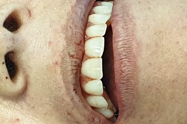 implantes cigomaticos