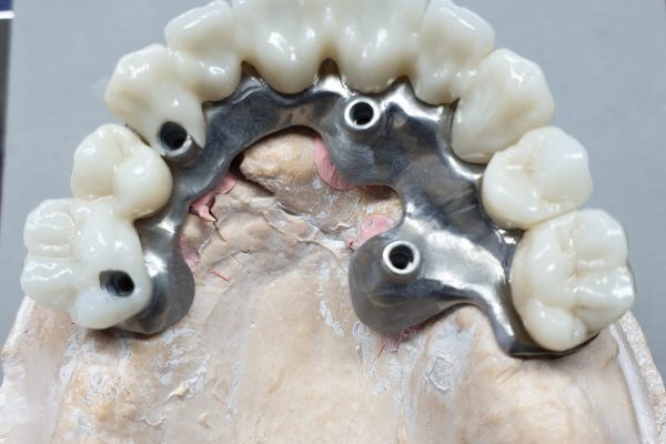 implantes cigomaticos