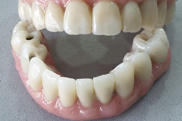 implantes cigomaticos