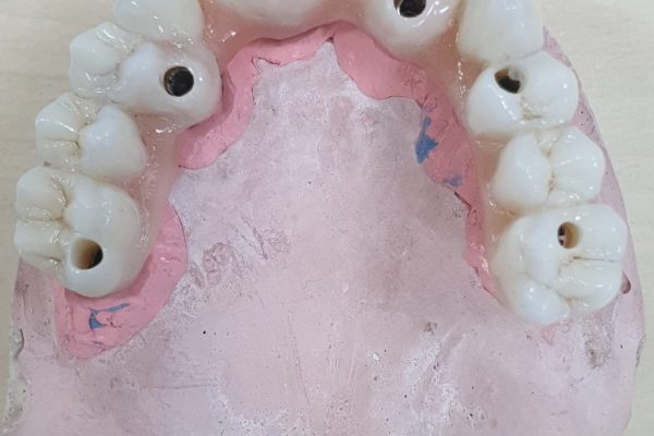 PERSONALIZACION DE PROTESIS