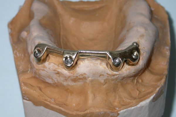 sobre implantes sobre implantes