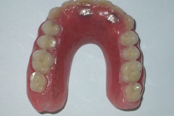 sobre implantes sobre implantes