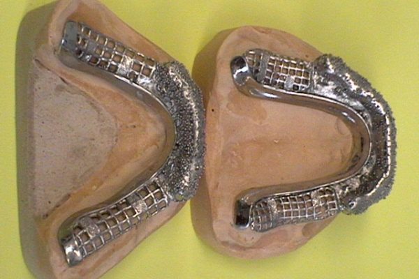 sobre implantes sobre implantes