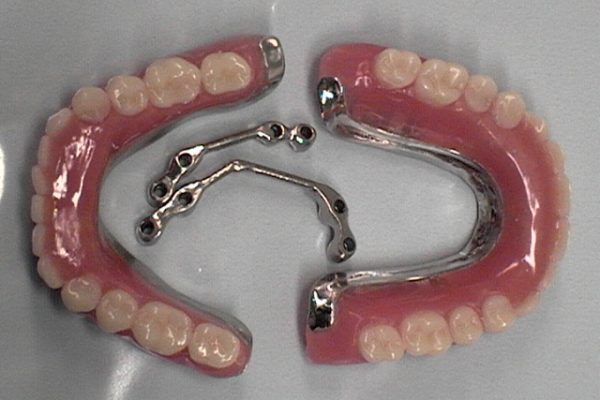sobre implantes sobre implantes