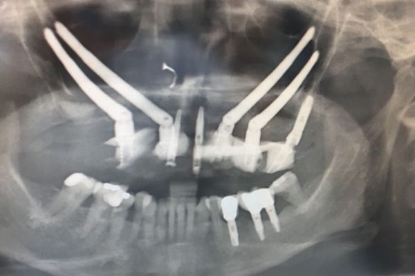 implantes cigomaticos