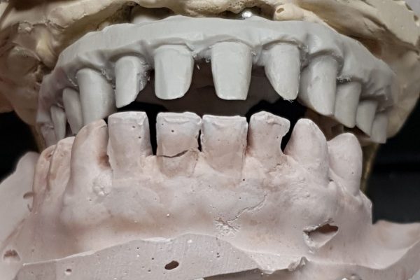 peek zirconio