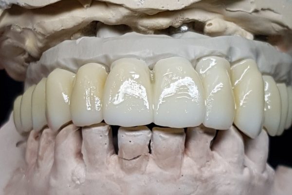 peek zirconio