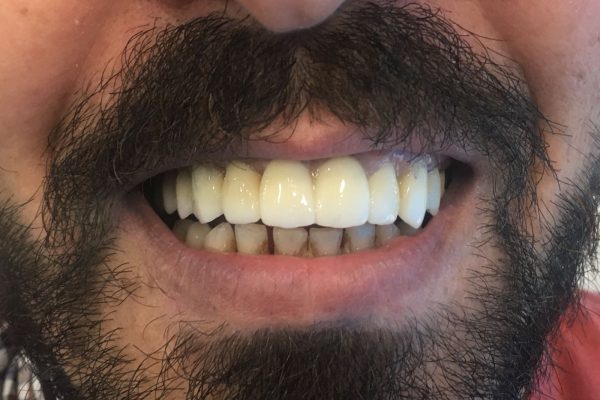implantes cigomaticos