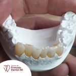 corona de zirconio
